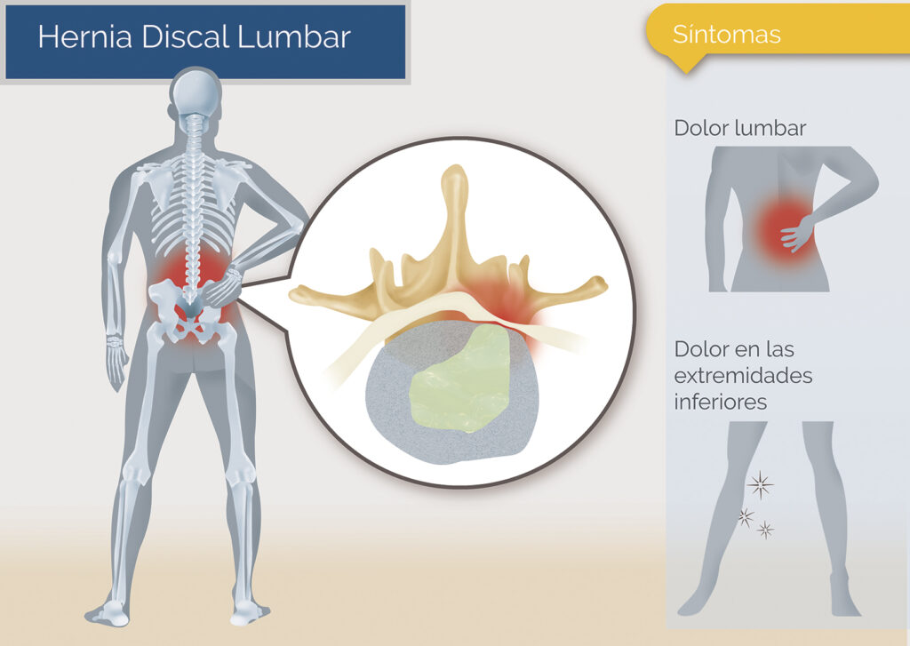 hernia discal lumbar