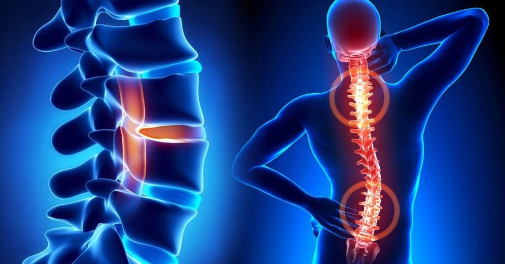 Las cinco lesiones más comunes de los discos intervertebrales