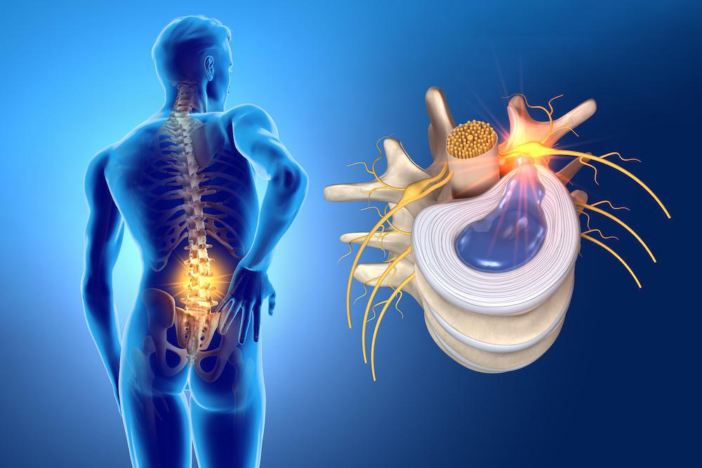 Hernias discales: tipos, síntomas y diagnóstico