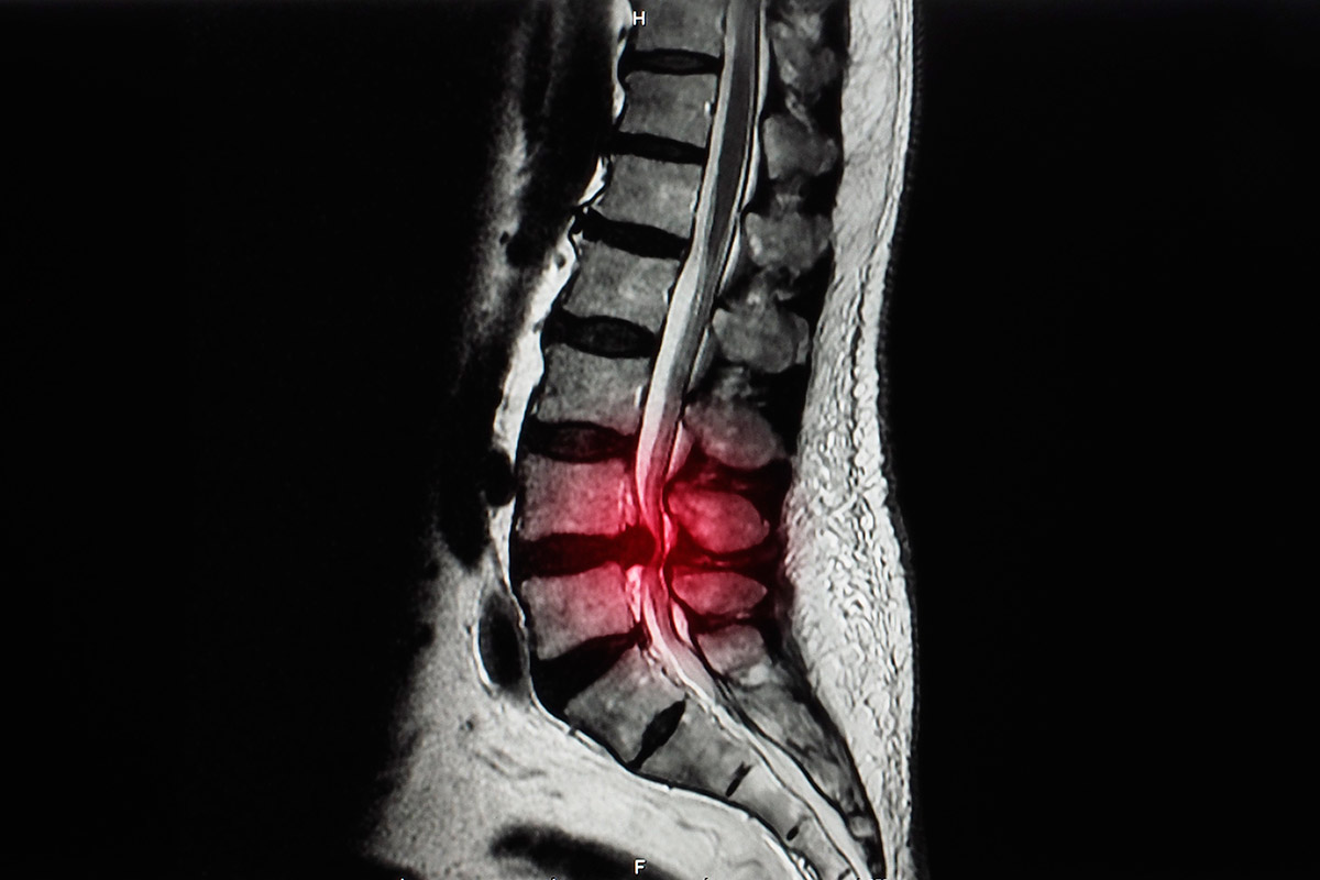 Laminectomía lumbar para descompresión del canal lumbar